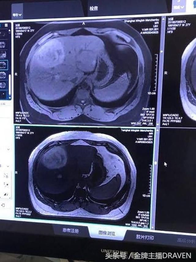 辟谣！嫖老师没有得肝癌，三天后才出诊断结果！