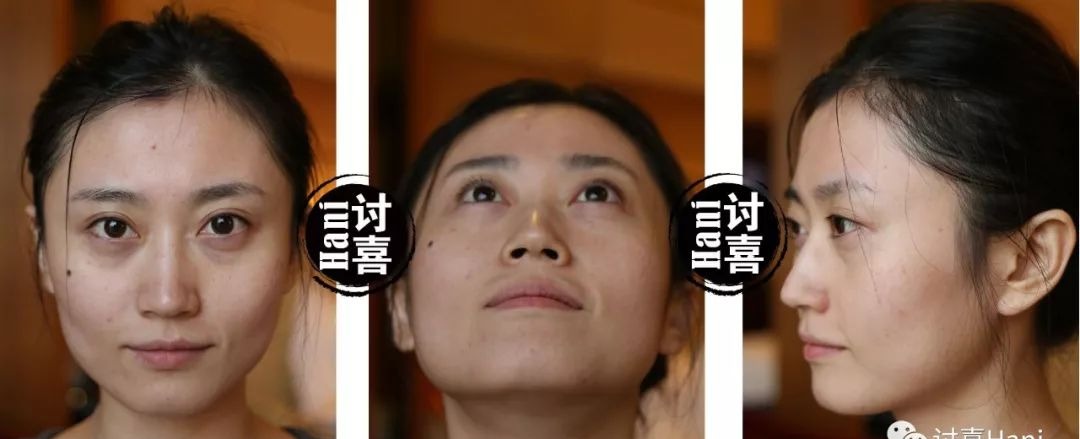 「衰老问题」素人整形分析 | 做对这些,宽方脸比瓜子脸更有优势