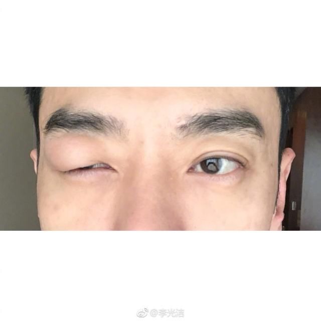 男星尴尬部位被蚊子咬后，导致整个剧组停工，网友：想上手摸一把