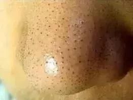 草莓鼻必看！一喷一抹，轻松把黑头分解掉！