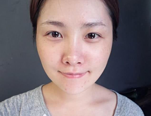 关于去黑头的皮肤管理知识！黑头不能挤？