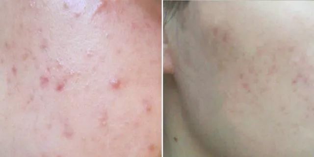 拔出黑头粉刺，地毯式清洁肌肤，还能缩小毛孔!素颜也自带妆容