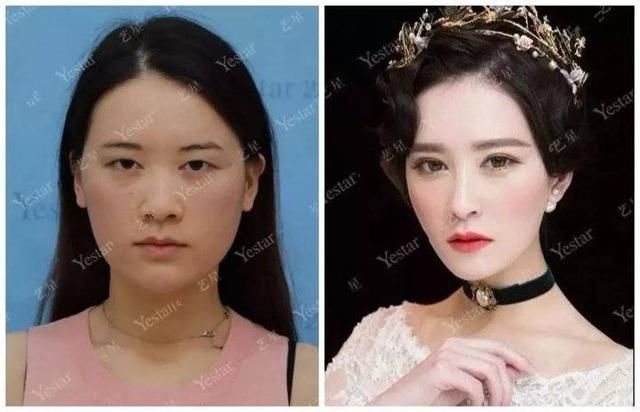  济南■「济南艺星双眼皮」别傻了！这种“无痕双眼皮”其实就是……