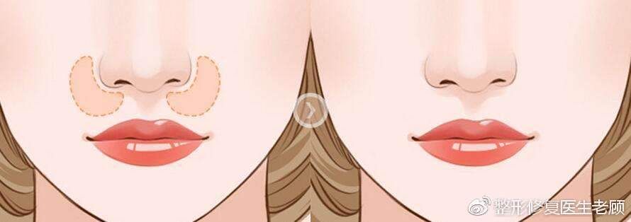 你连鼻基底是什么都不知道，还想有个好看的鼻子?