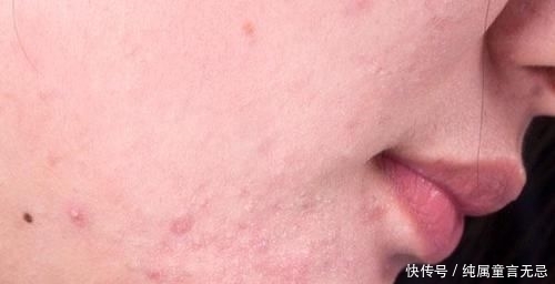  去除|抿嘴时，下巴上密密麻麻的白色小疙瘩，是什么？怎么才能去除？