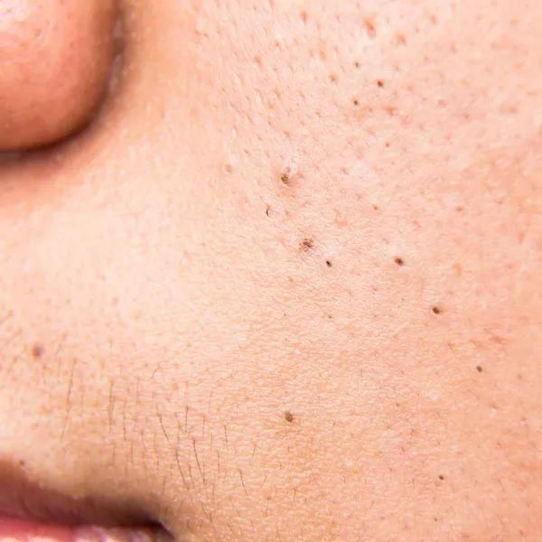 顽固黑头，一招去除，嫩白效果比美颜相机还好!