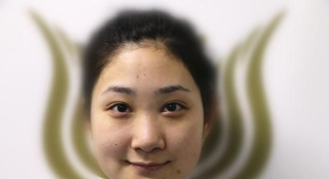  手术@隆鼻真的对颜值有影响吗？女孩术后真实记录，简直换了一个人！