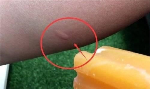  「招真」蚊子包止痒5大方法，只有这招真有用！生活小秘诀