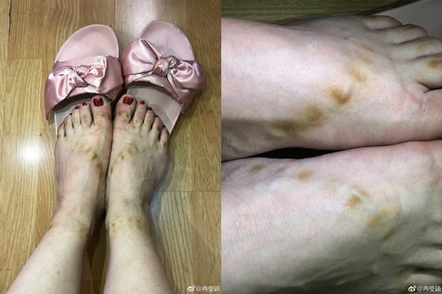 冉莹颖穿了十个小时的高跟鞋，脱下鞋后双脚触目惊心！