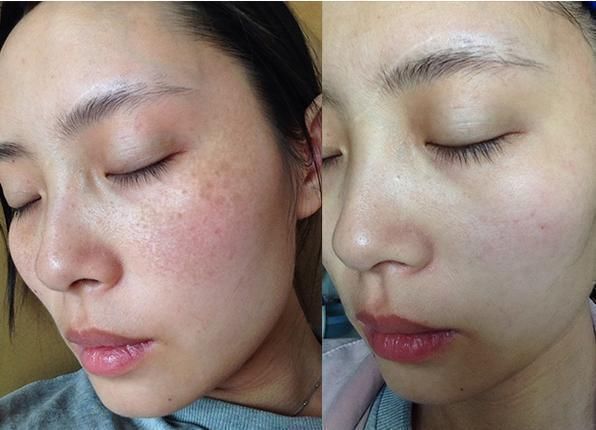 红霉素软膏不能祛斑。白醋+它抹脸,三次美白,祛斑强过激光30倍