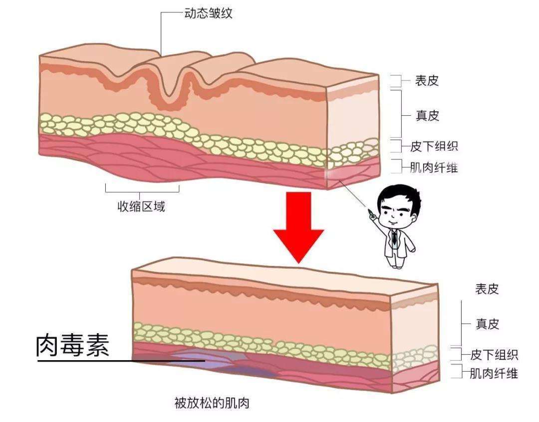 『法令纹出现』别让你的法令纹,泄露了你的年龄!