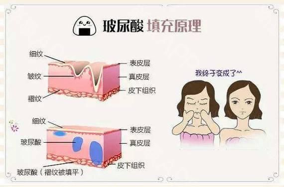  脸上：带你们细数一下，她们脸上有多少支玻尿酸？