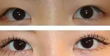 一双眼睛毁掉整张脸，这几种眼睛做双眼皮美爆了，有你没有？
