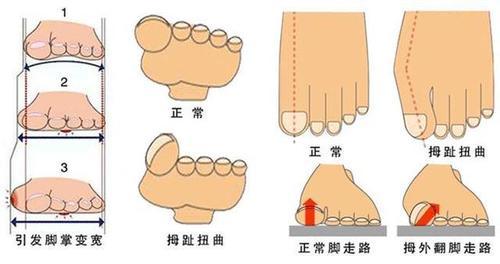 那些长期穿高跟鞋的,脚都变成什么样了?