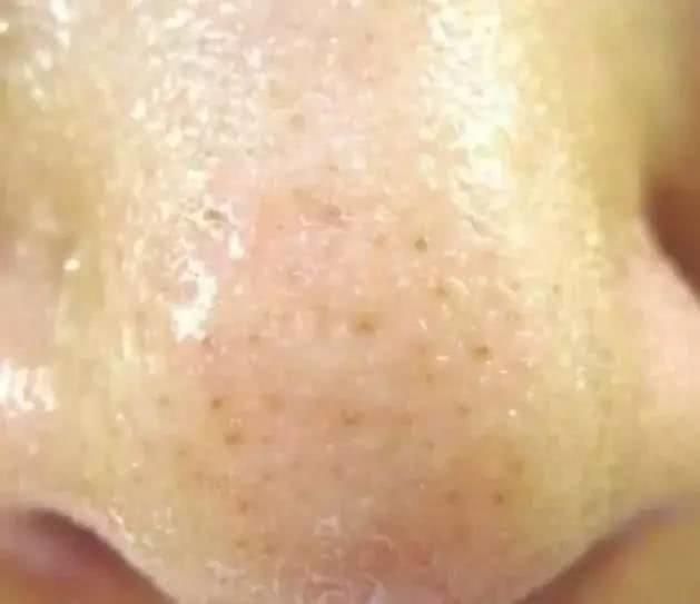 鼻子不断挤出“黄条物”，说明毛孔螨虫已破亿，教你2招能除螨