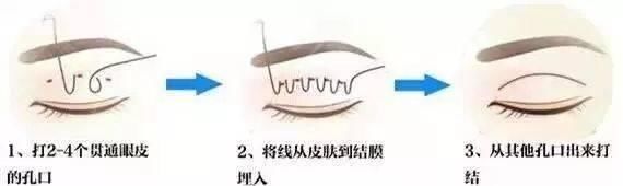  『竟然』什么？你做的双眼皮竟然消失了