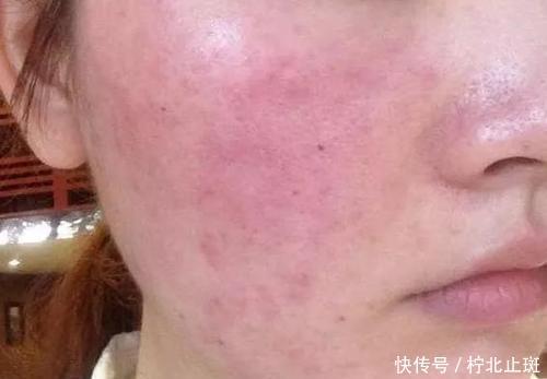  泛红@敏感肌最难熬的季节来了，这样护肤，彻底告别干燥泛红和瘙痒