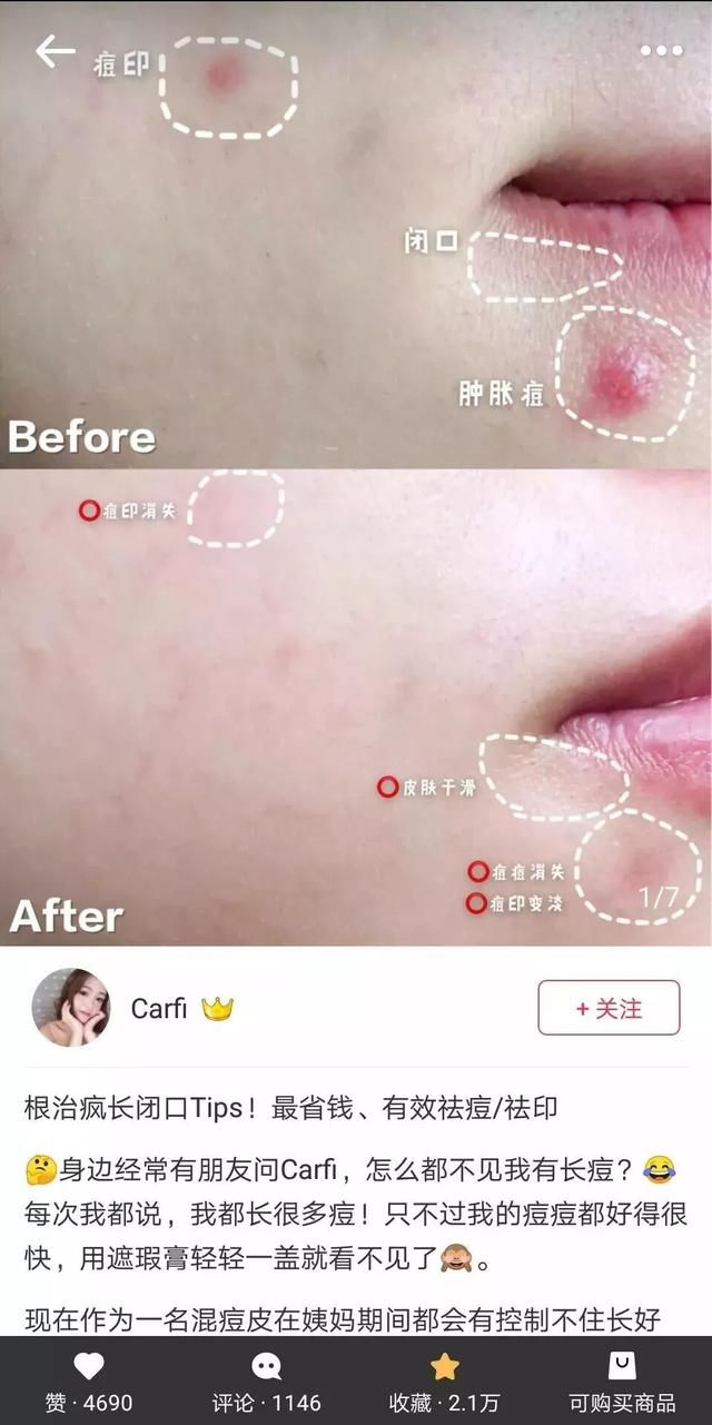 满脸痘怎么见人?用了这个去痘不留印的神器,我把200块的遮瑕都