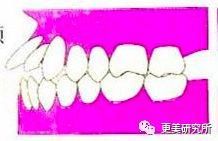 “整牙到底能不能瘦脸”终于有了权威结论，杨幂竟是被冤枉的?