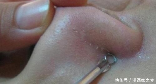  【鸡蛋】鼻子上挤出“白色条状物”？学会这3招，或与“草莓鼻”说拜拜呦！