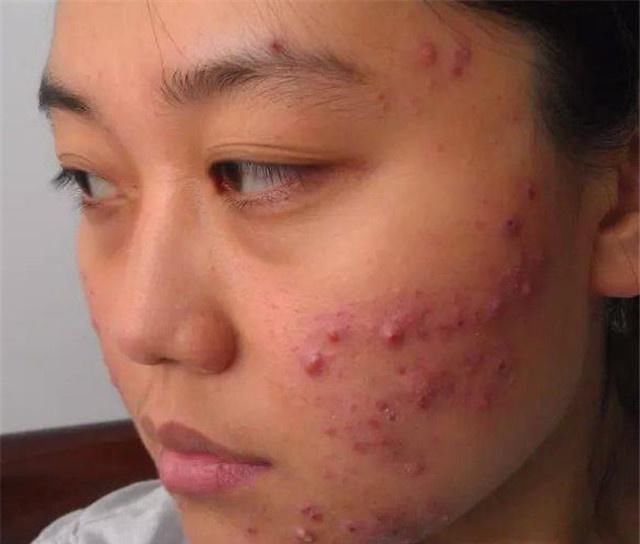 脸上出油长痘都是螨虫多，每晚抹点它轻松祛螨，可惜很少人知道