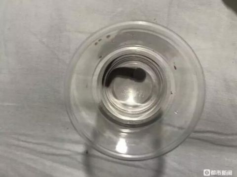  「张秋芬」贵州7岁男孩反复流鼻血，到医院一查，鼻腔内竟取出这