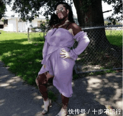 黑人女子皮肤一块块变白, 因次成为网红, 原因却让人感到同情