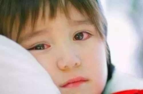 孩子眼睛充血红肿?警惕红眼病的传染