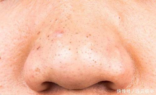  [不住]睡前坚持好4个好习惯，一个月甩掉痘痘黑头，可惜很多人坚持不住