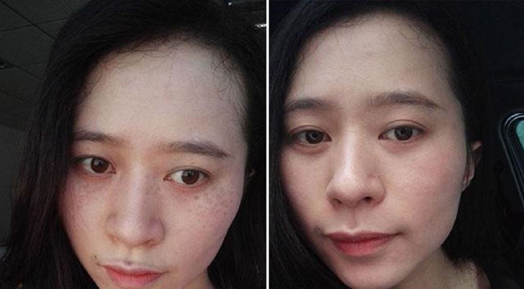 『皮肤』长斑怎么办?简单1招教你调理,坚持皮肤变白净!