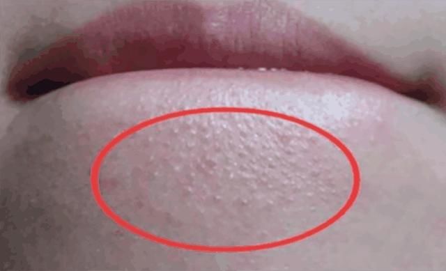 抿嘴后下巴毛孔凸起“白米粒”! 清除用2招就好