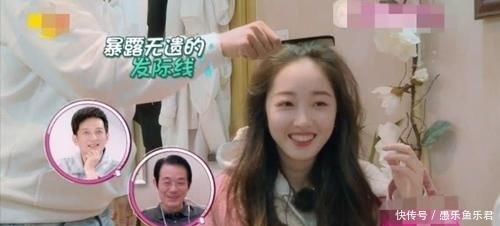 急需■蒋梦婕脱发严重!发际线真的高出天际,急需植发补救