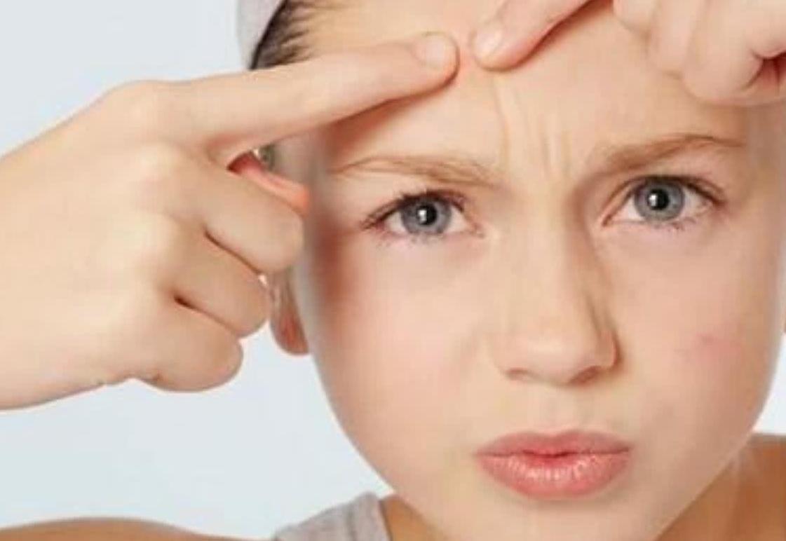 长痘痘者：护肤谨记“3少2多”，痘痘消得快，脸会更加细腻平整