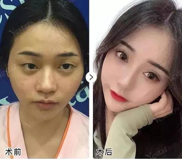  济南■「济南艺星双眼皮」别傻了！这种“无痕双眼皮”其实就是……