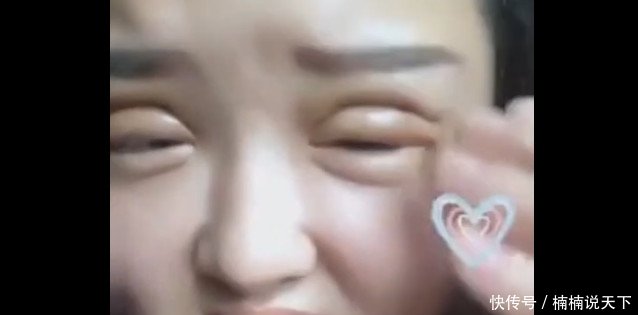 刚割完双眼皮的脸，你确定是在变美让人有些不忍直视！