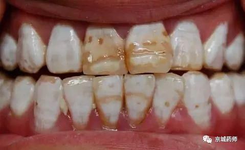 你家的牙膏真的适合你吗?专家告诉你,牙膏应该这样选