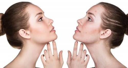 皮肤@解析为什么越蒸痘痘越多 怎样有效缓解皮肤问题