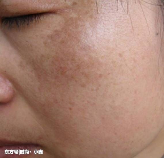 大妈用一勺蜂蜜加它抹脸，祛斑快的像激光枪，10分钟斑点全跑光