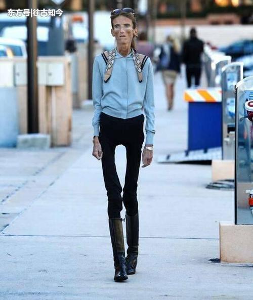 女子身高1.73米, 体重只有50斤, 廋成了一具“干尸”