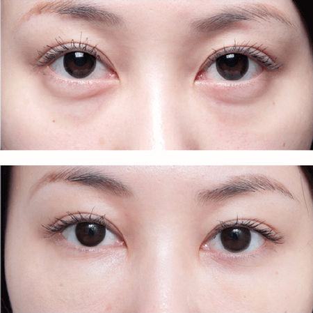 眼周脂肪粒惹人厌?别慌别挤，只需一招，闪电去除还不留痕