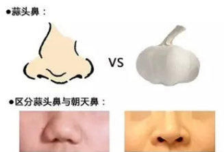  值得@科普一下：拯救“蒜头鼻”方法值得收藏~