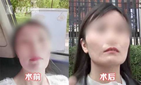 『整容』脸太瘦不够“旺夫”？女子花4万整容 结果成了这样