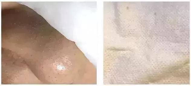 草莓鼻必看!一喷一抹,轻松把黑头分解掉!