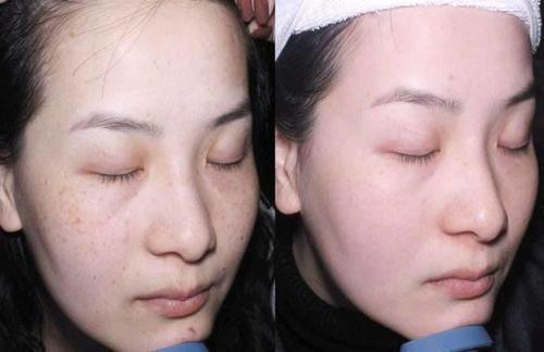 药店常见的一软膏，每天用它涂下脸，祛除斑点美白嫩肤