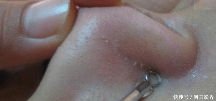  水油平衡■抿紧下巴后突起的“白疙瘩”，千万要注意，这是螨虫的真身吗