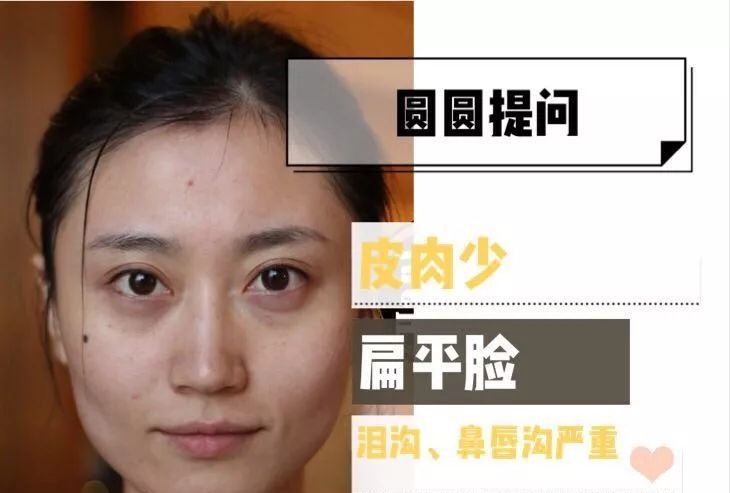 「衰老问题」素人整形分析 | 做对这些,宽方脸比瓜子脸更有优势