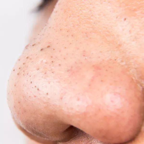 顽固黑头，一招去除，嫩白效果比美颜相机还好!