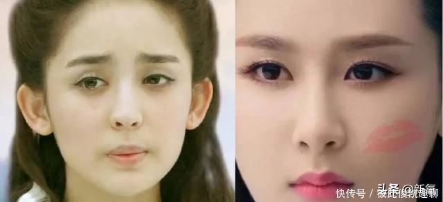 变了鼻基底假体厚到合不上嘴!变猴型上颌