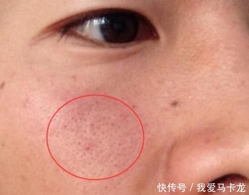  「毛孔粗大」女生脸上毛孔大到能插秧？教你3个小窍门，助你皮肤Q弹似果冻