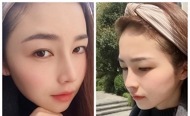  #术后#隆鼻真的有用吗？鼻综合术后六个月记录，这完全不是一个人！
